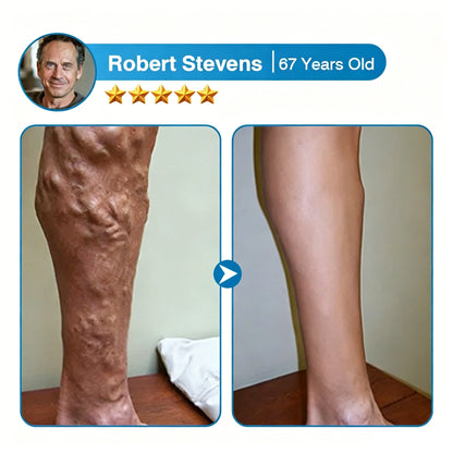 🇨🇦🏆✅️🏃Femscoop® VeinRepair Microneedle Patch Roll⚡Instant Relief, Long-Term Results