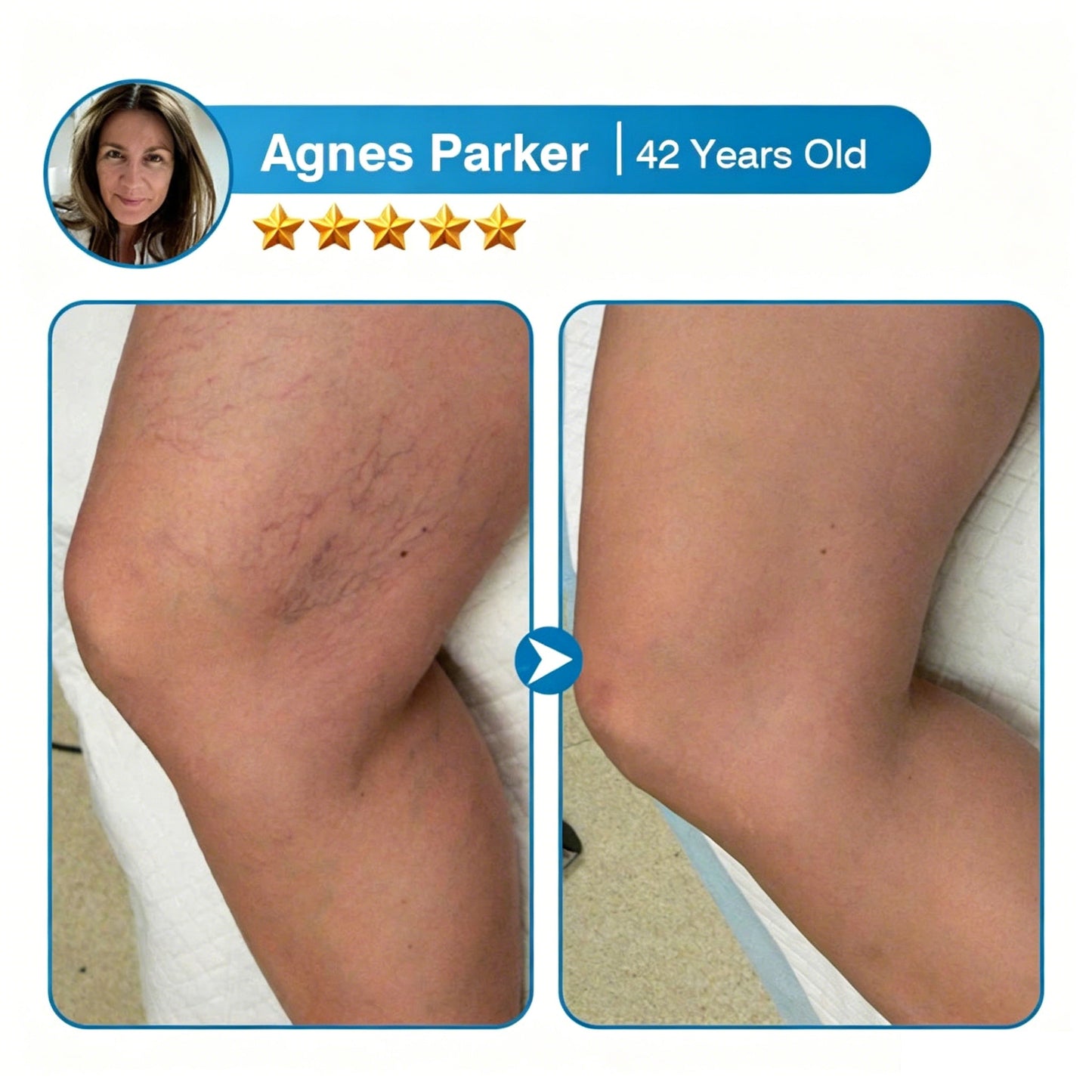 🇨🇦🏆✅️🏃Femscoop® VeinRepair Microneedle Patch Roll⚡Instant Relief, Long-Term Results